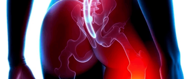 Sciatica Treatment